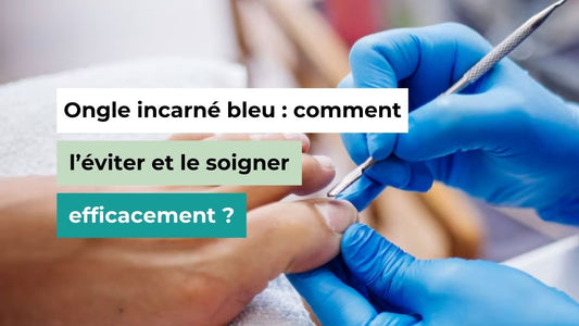 Ongle incarné bleu : comment l’éviter et le soigner efficacement ? - Semello.fr