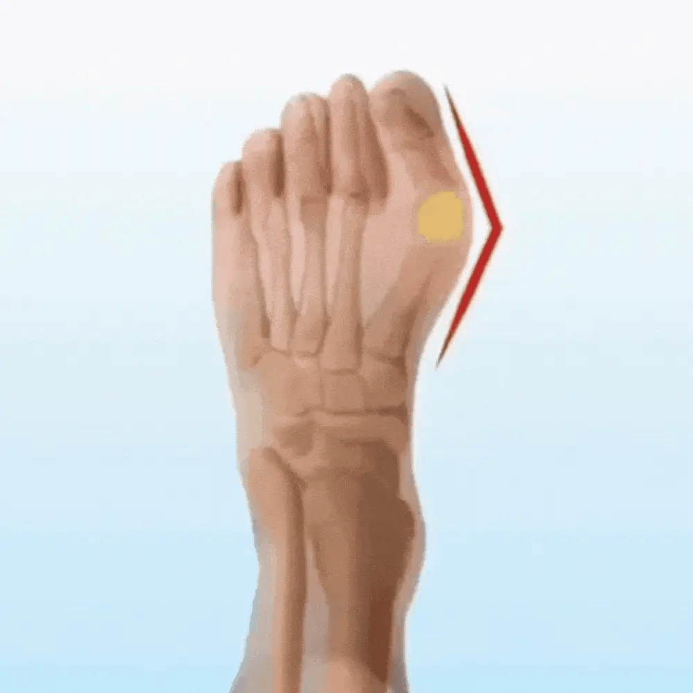 Chaussettes Correctrices Hallux Valgus Semello - Semello.fr