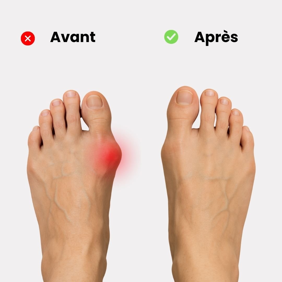 Orhèse hallux valgus de nuit - Semello.fr