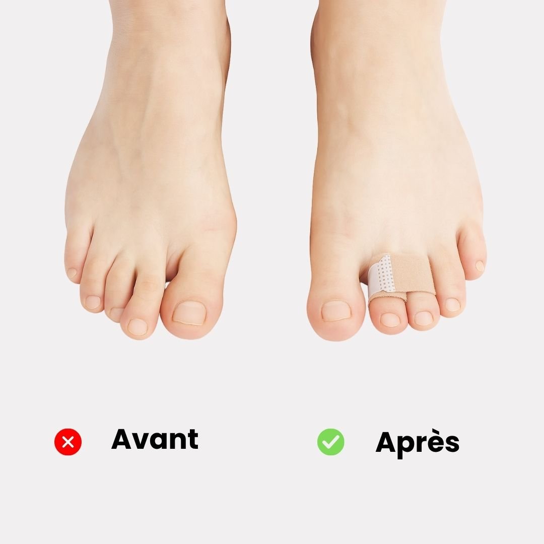 Strap Correcteur Orteil en Griffe - Semello.fr