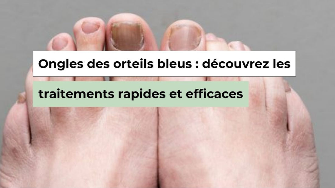 Ongles des orteils bleus : pourquoi cela arrive et que faire - Semello.fr