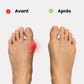 Orthèse orteil souple et discrète pour Hallux Valgus