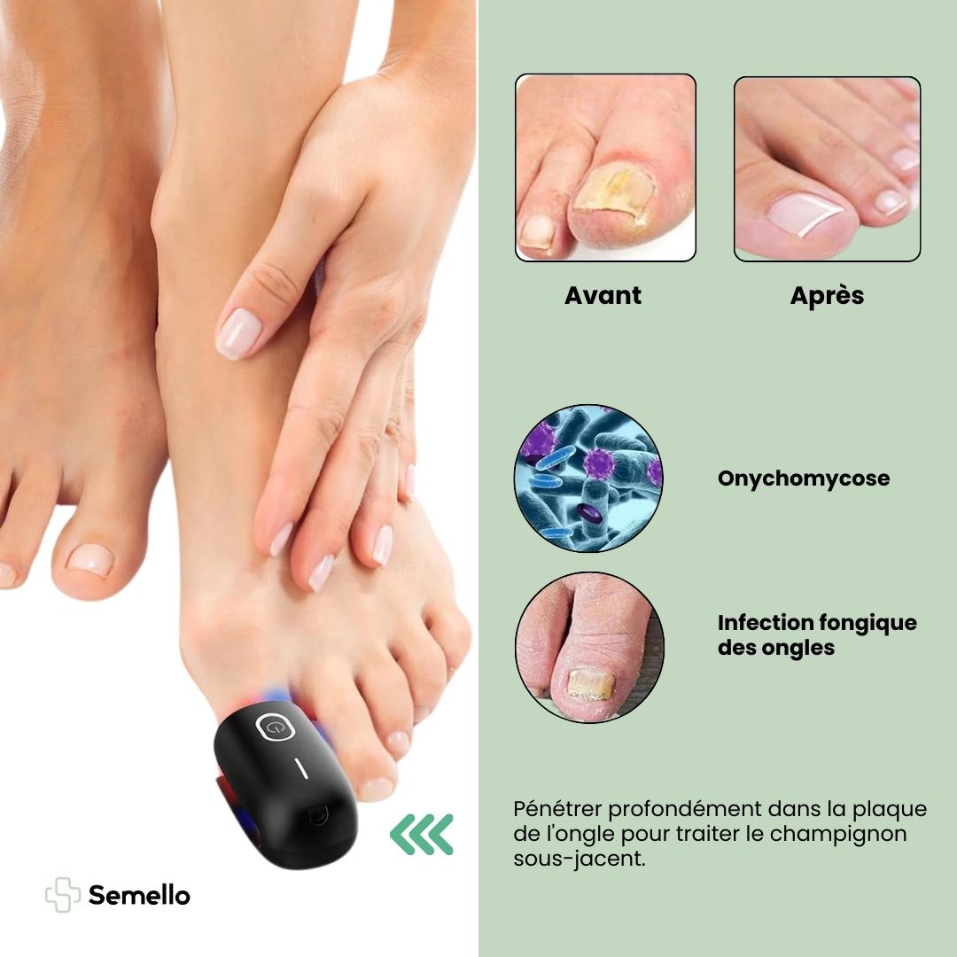 Appareil de traitement des Mycoses Rapide - Semello.fr