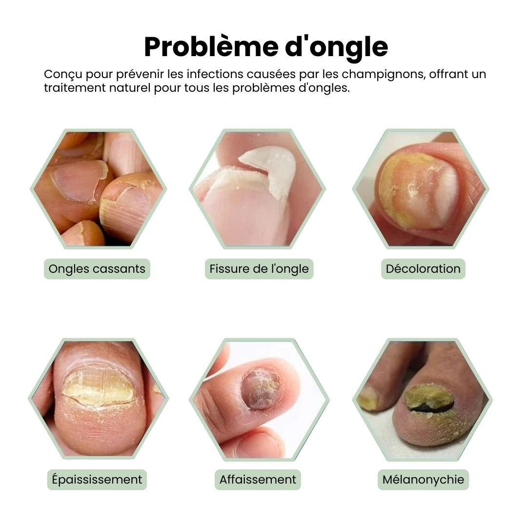 Appareil de traitement des Mycoses Rapide - Semello.fr