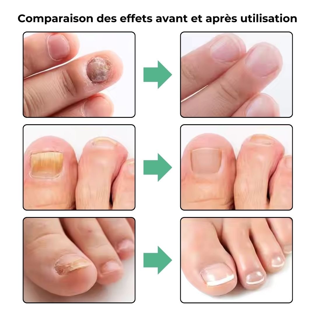 Appareil de traitement des Mycoses Rapide - Semello.fr