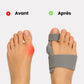 Attelle Hallux Valgus Articulable - Semello.fr