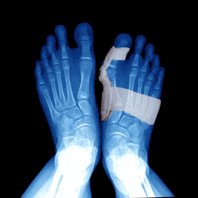 Attelle amovible de nuit pour Hallux Valgus