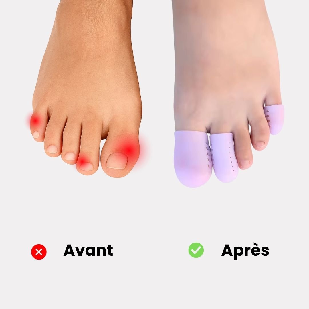 Lot de 3 Orthèses pour les Orteil en Griffe (Taille universelle) - Semello.fr