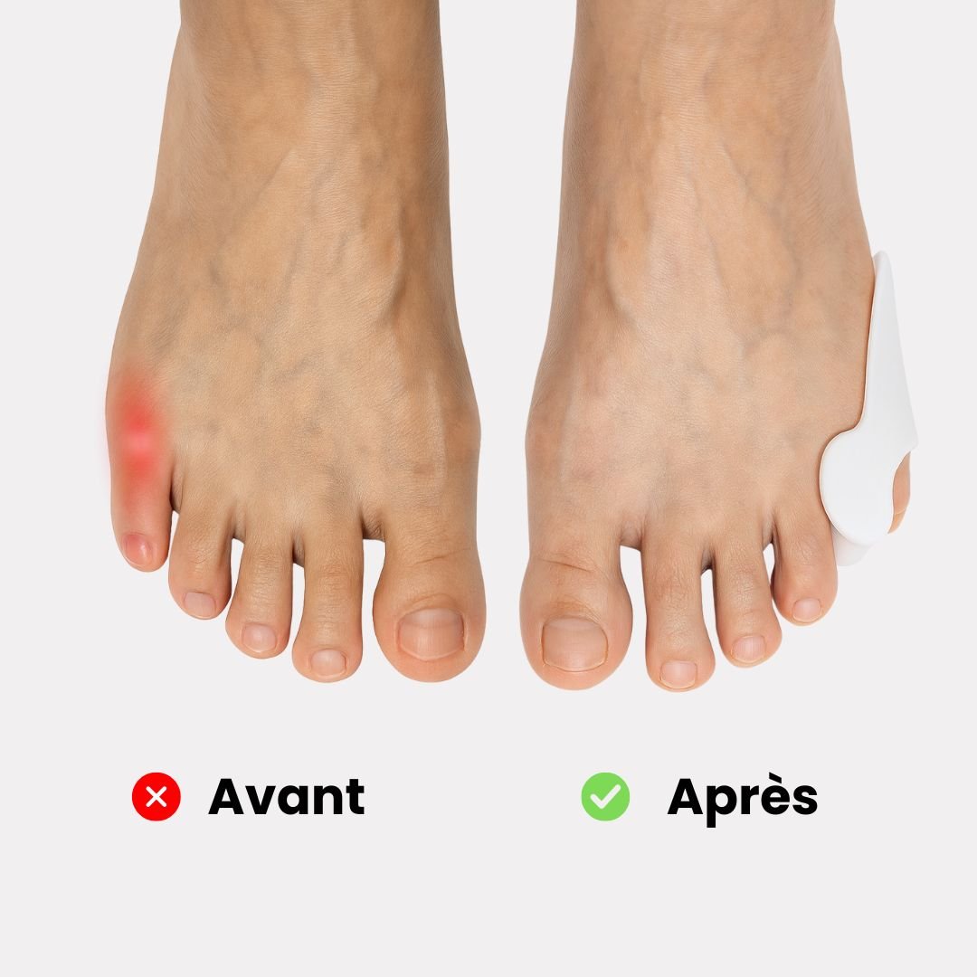 Orthèse Petit Orteil en Silicone - Semello.fr