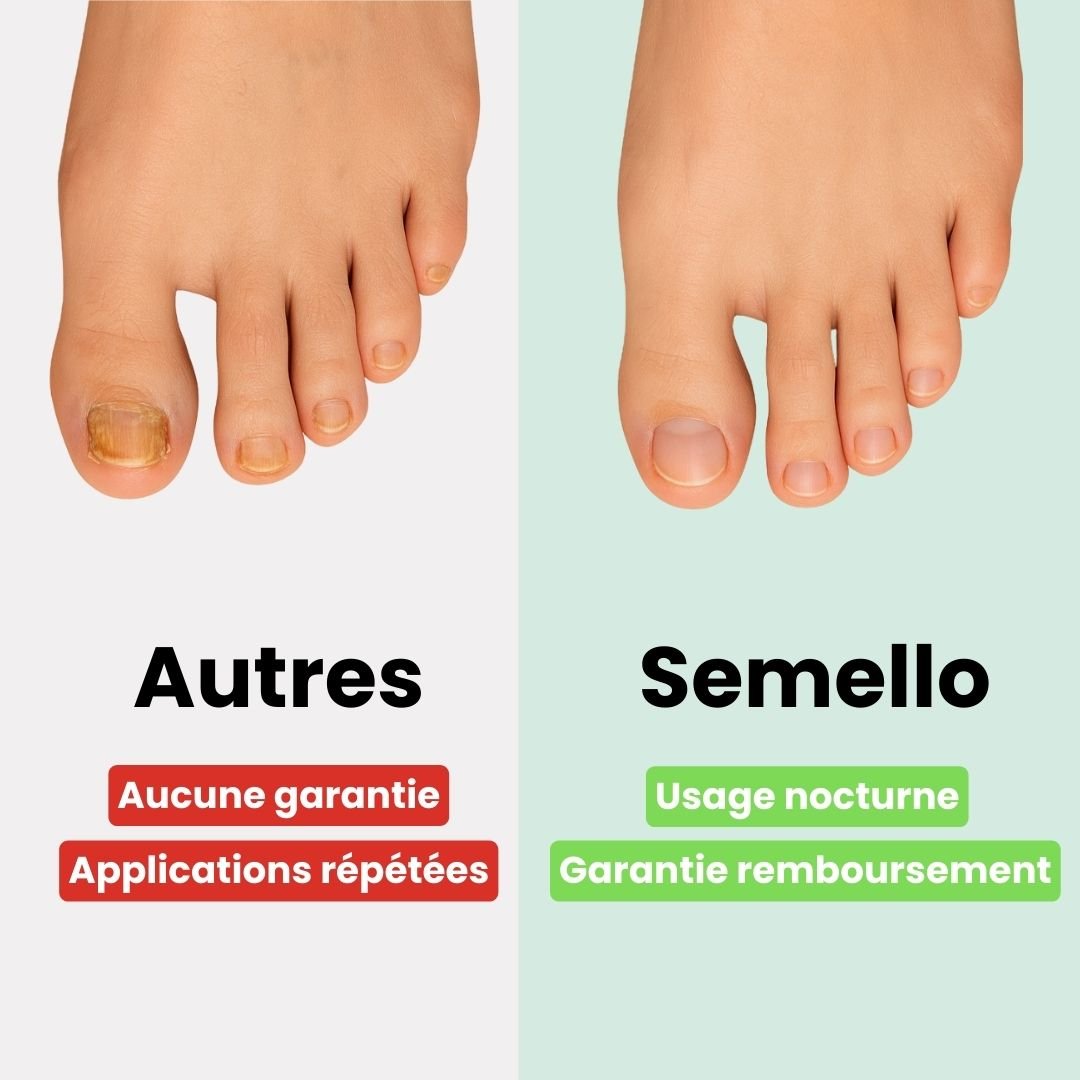 Patchs et Sérum contre les Mycoses des Ongles - Semello.fr