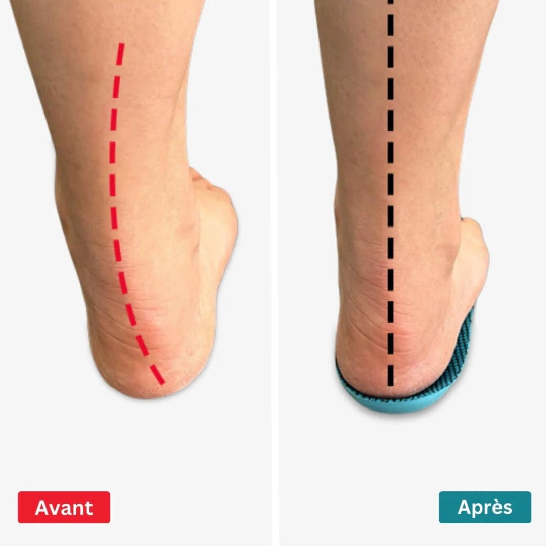 Semelles orthopédiques hallux valgus - Semello.fr